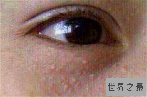 脂肪粒怎么去除 脂肪粒的产生和眼酸有着很大关系