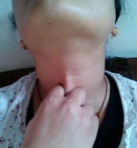 ​喜欢揪痧的人都是美丽的（经常揪痧有什么健康好处）