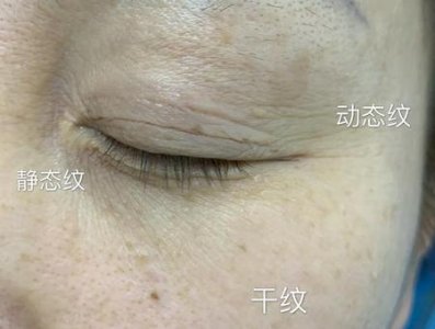 ​用什么可以消除眼纹(眼霜按摩仪有用吗)
