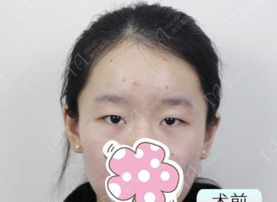 ​整容会后悔吗(整容后有多少后悔的)