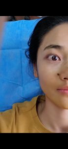 ​简单快速自己去痣（与各位友友分享去痣历程）