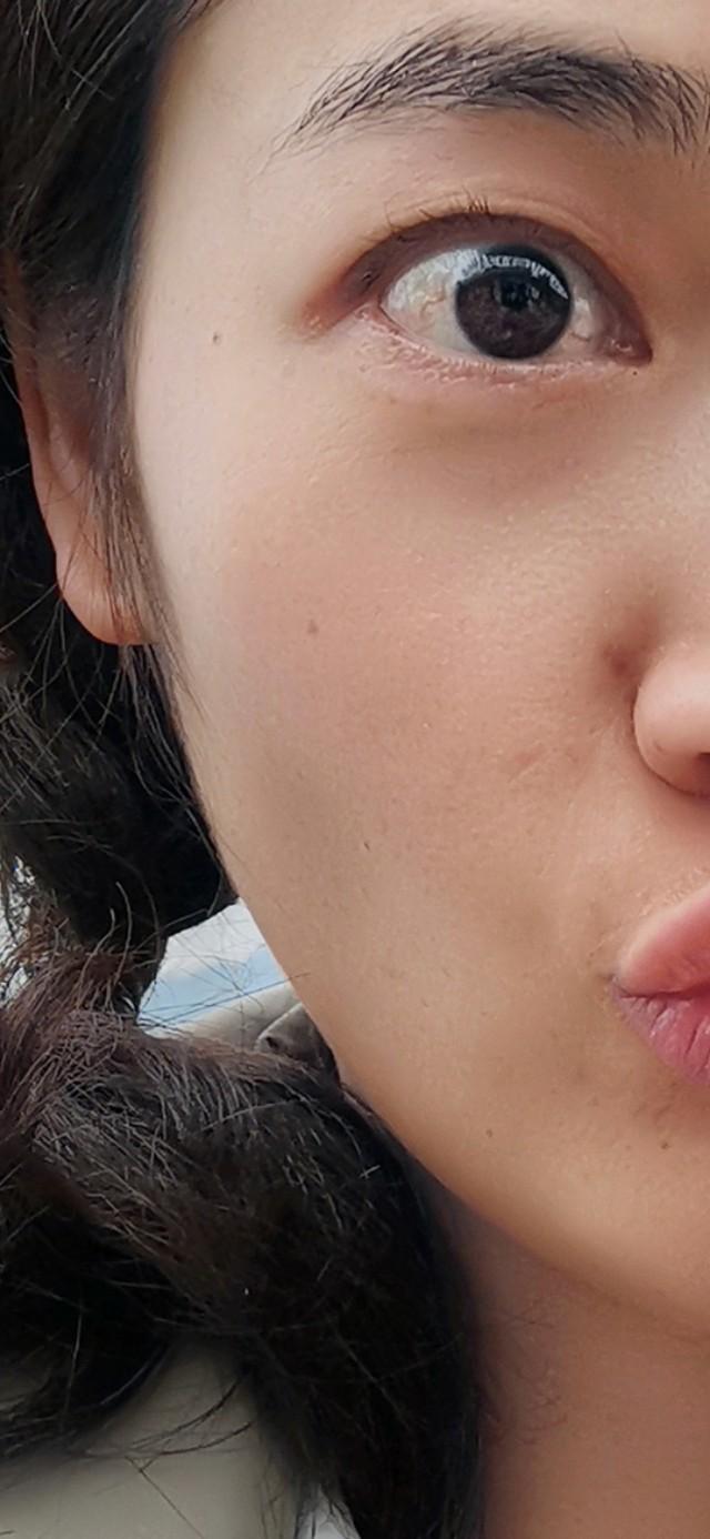 简单快速自己去痣(与各位友友分享去痣历程)(2)