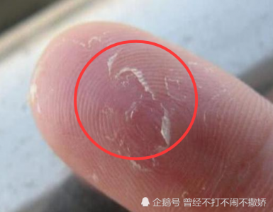 ​手指脱皮是什么原因（手指脱皮是身体发出的求救信号）