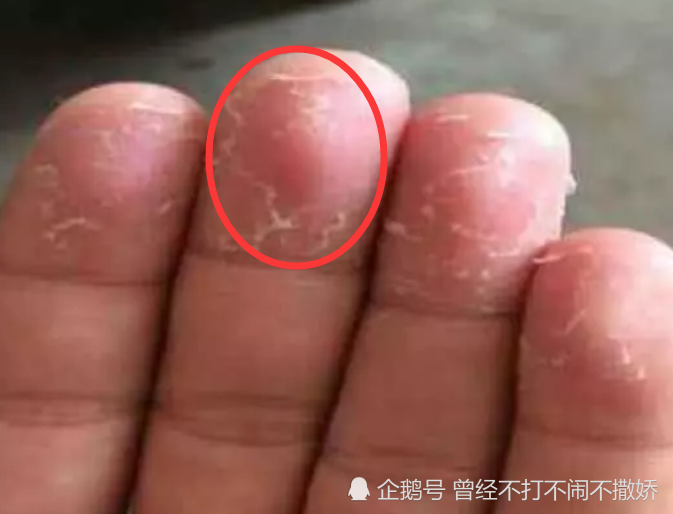 手指脱皮是什么原因(手指脱皮是身体发出的求救信号)