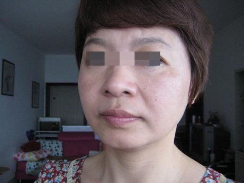 黄褐斑去除最有效的办法,黄褐斑去除多少钱-第1张图片-