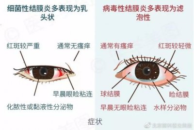 ​眼结膜有水泡 结膜水泡多因过敏