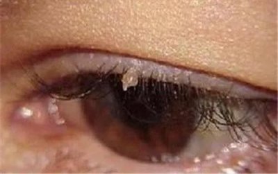 ​丝状疣是什么--丝状疣是什么原因引起的？