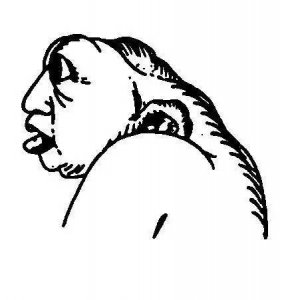 ​先天畸形胎儿--无脑儿