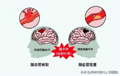 ​小握手，大讲究！波巴斯（bobath）握手康复操了解下