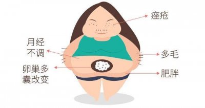 ​梁婉迪医生讲述多囊卵巢综合症的症状和治疗
