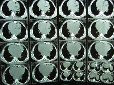 ​慢性心包炎 男女患病概率相同，预后较好